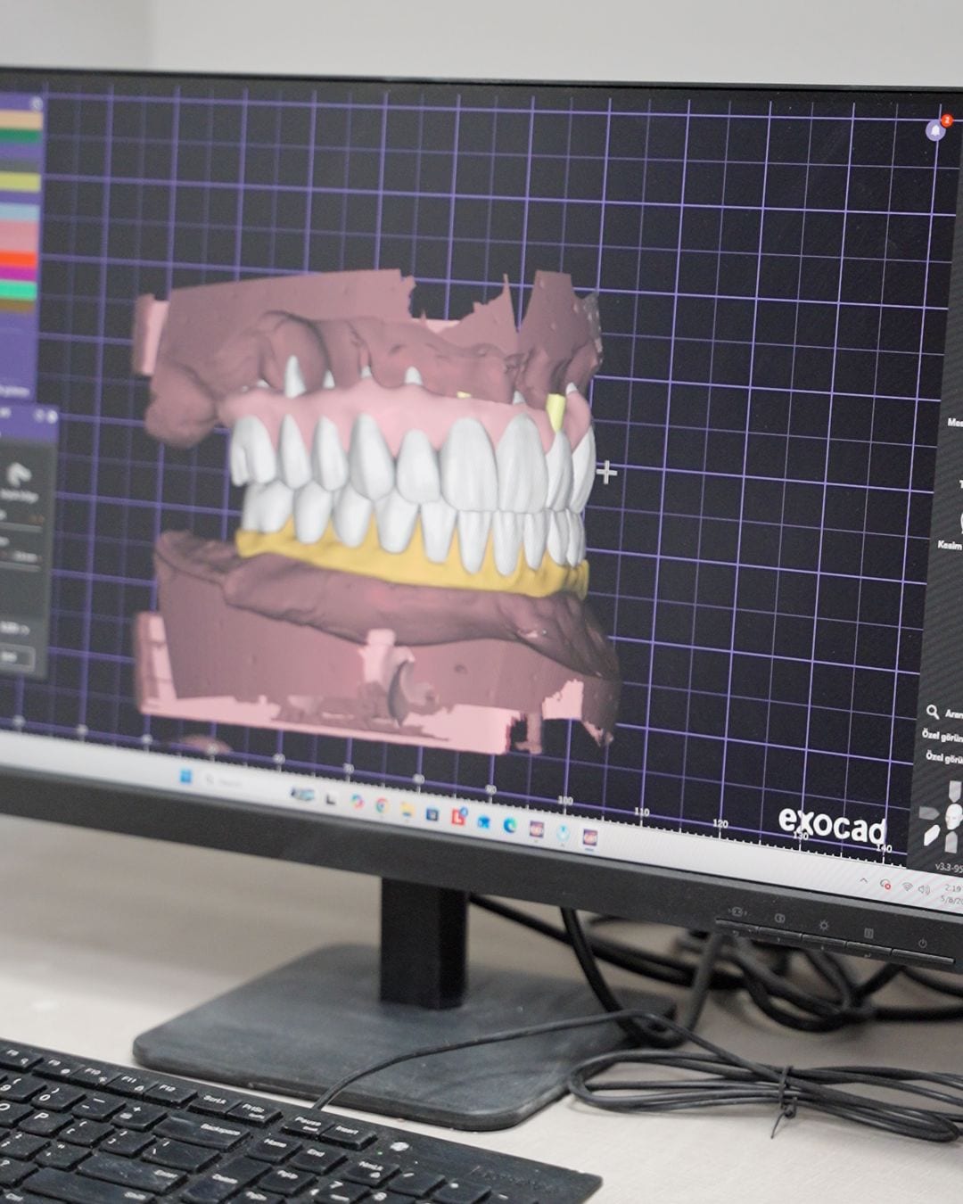 All-on-4 Implants